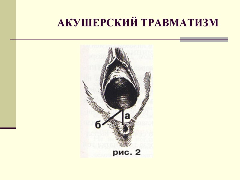 АКУШЕРСКИЙ ТРАВМАТИЗМ